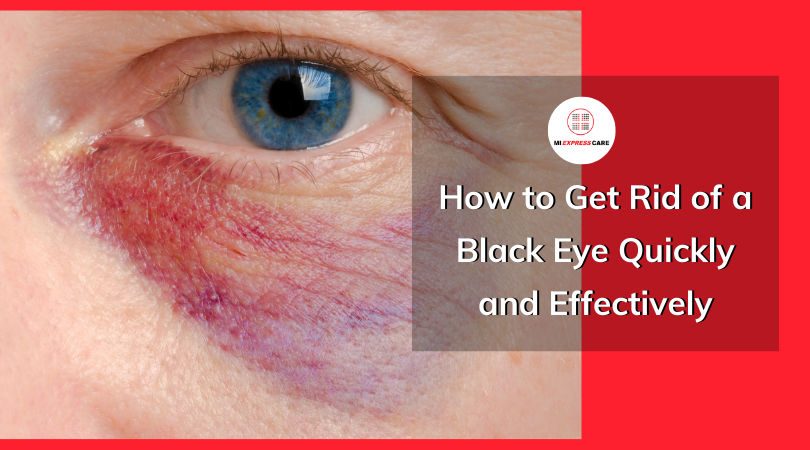 Black eye: What causes it and how to treat it