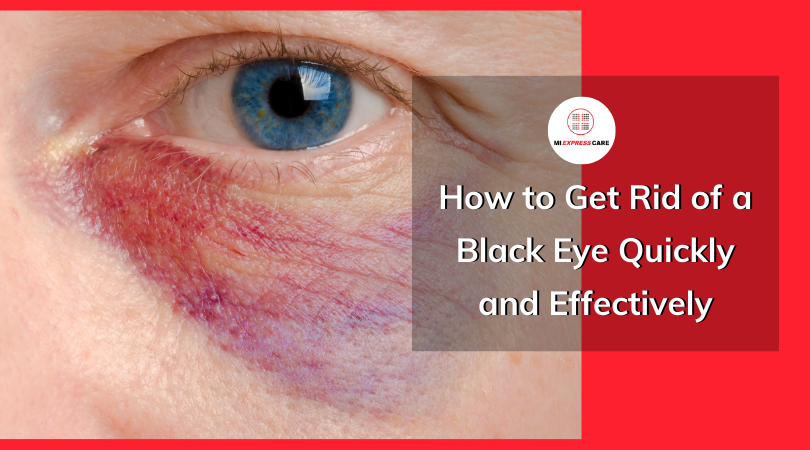 How to Get Rid of a Black Eye Quickly and Effectively