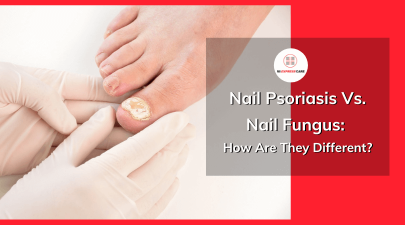 Nail Psoriasis Vs. Nail Fungus: How Are They Different?