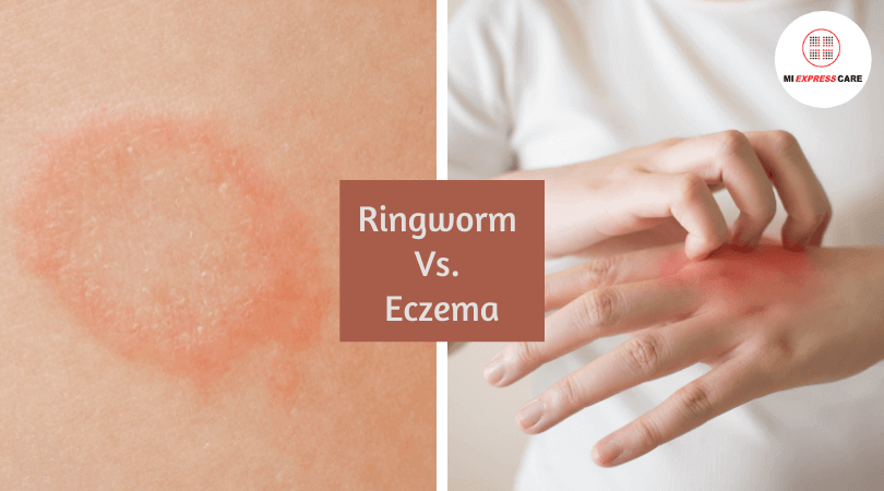 Ringworm Vs. Eczema: What Is the Difference?